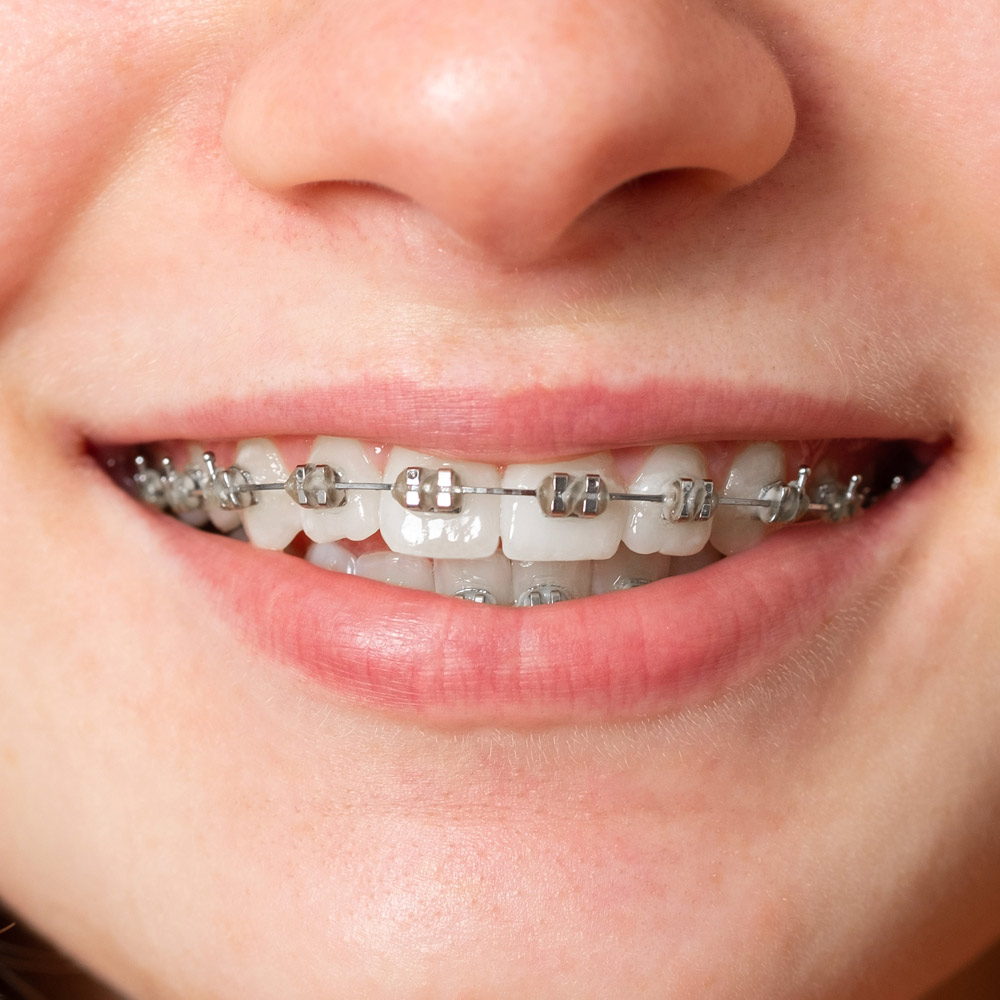 Invisalign (Clear Braces) Las Vegas Henderson NV