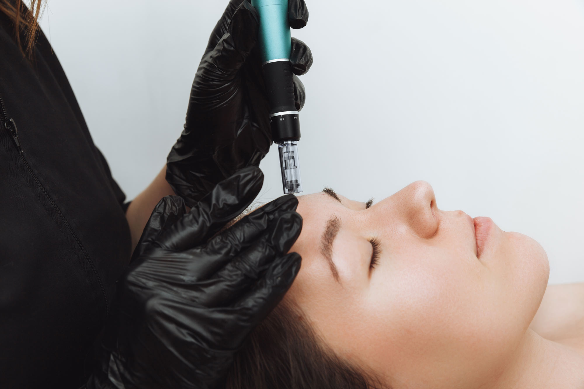 Woman receiving microneedling
