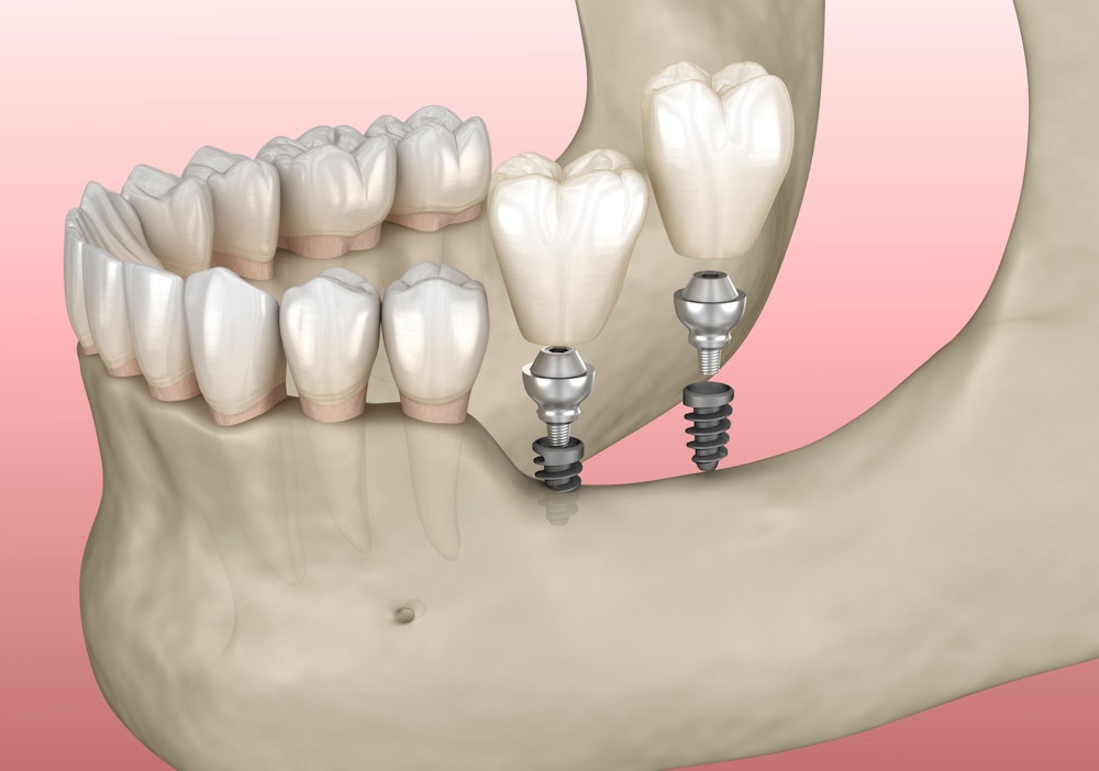 Mini dental implants