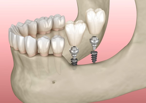 Illustration of implant-supported crowns