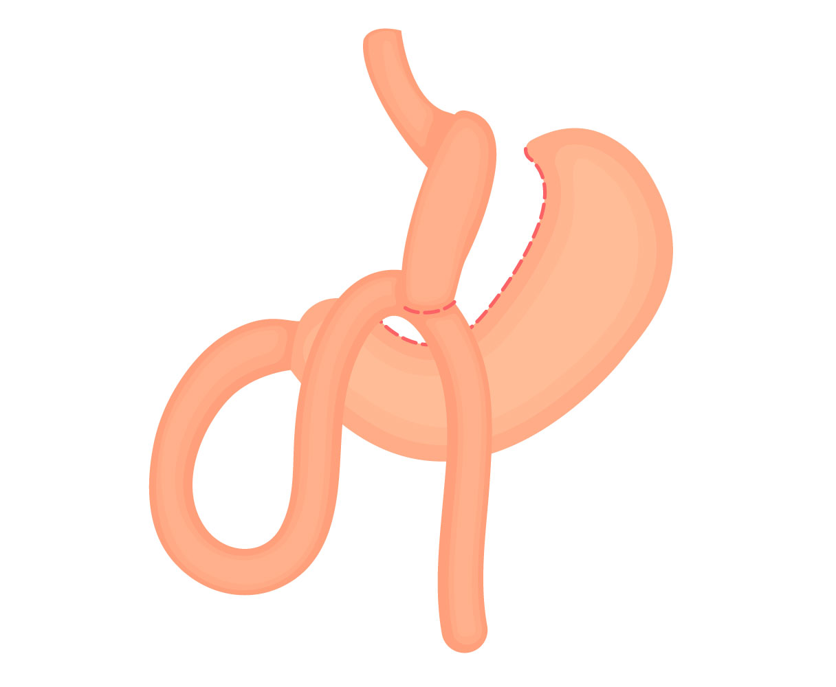 Mini gastric bypass procedure illustration