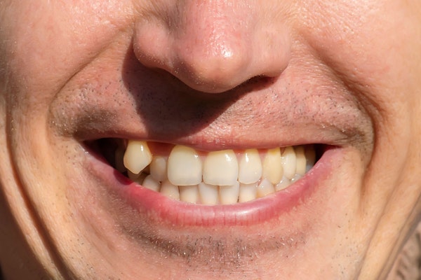 moderately crooked teeth