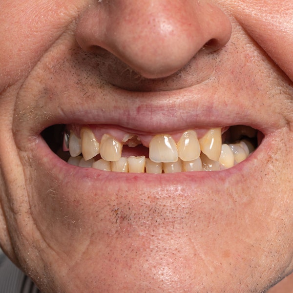 Missing teeth