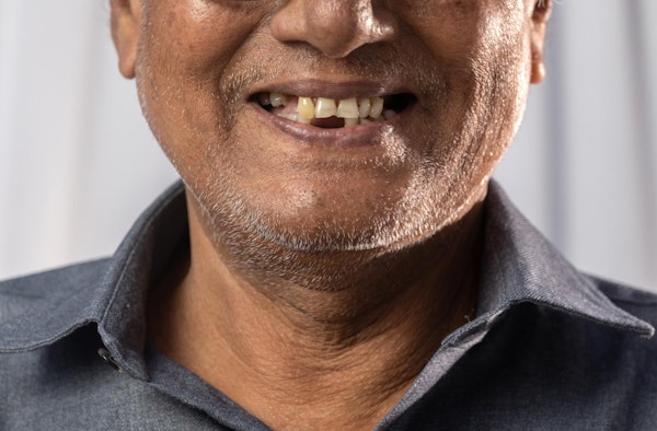 Man missing teeth