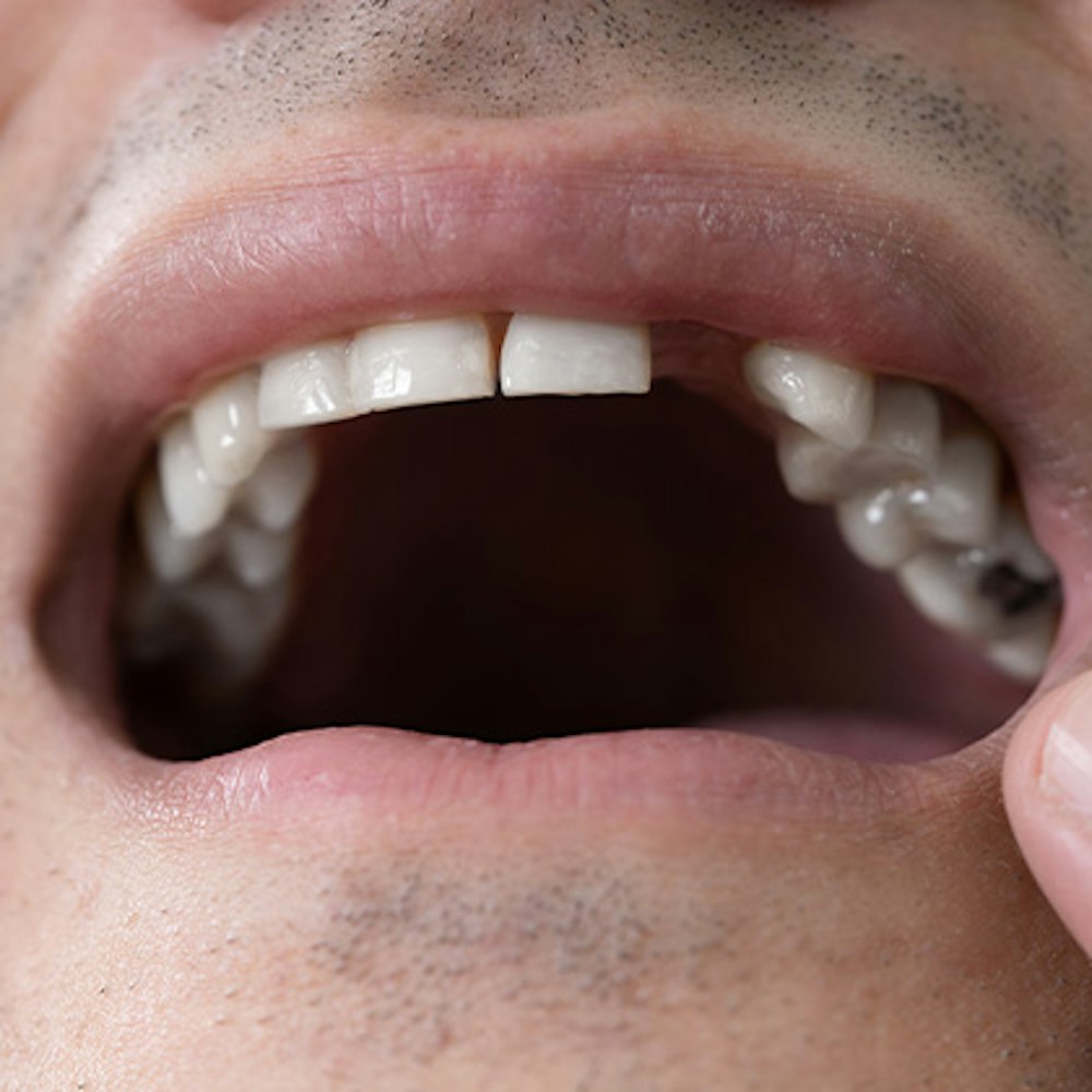 Person with missing tooth