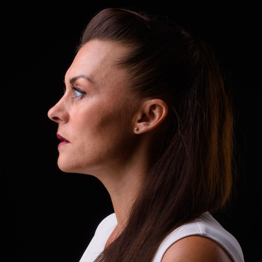 Woman's side profile after a neck lift