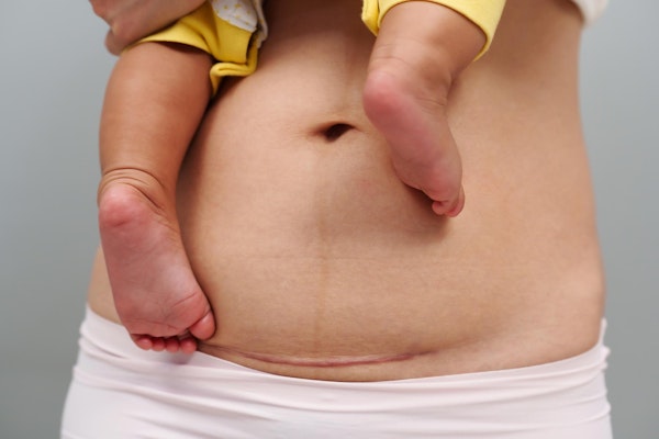 Stomach of mother's c-section, and legs of baby she is holding