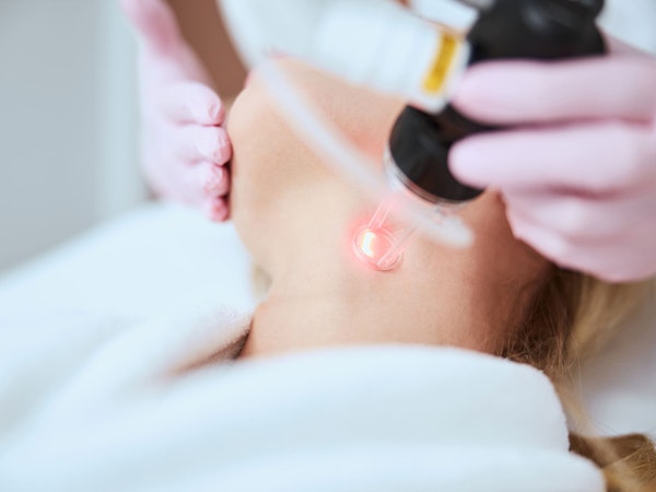 Laser Resurfacing
