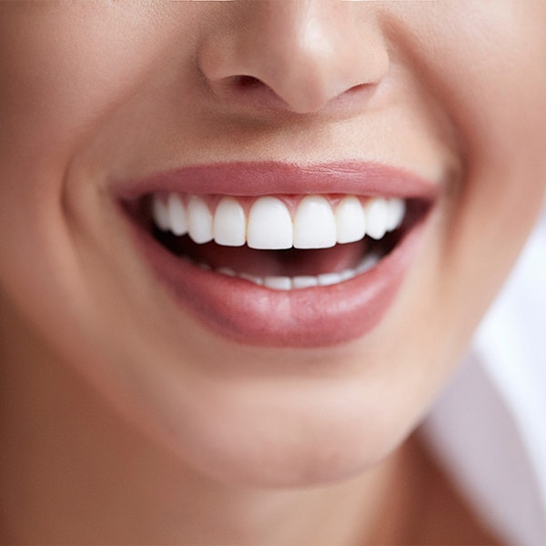 Dental Bonding vs. Veneers - Nashville, TN - Clint Newman, DDS