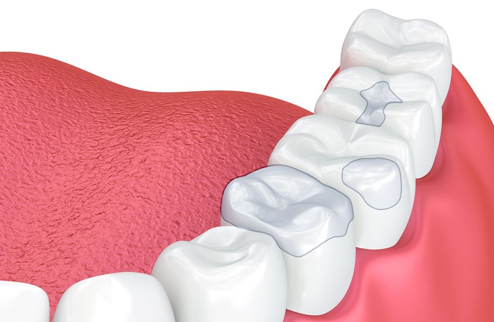 dental inlays and onlays