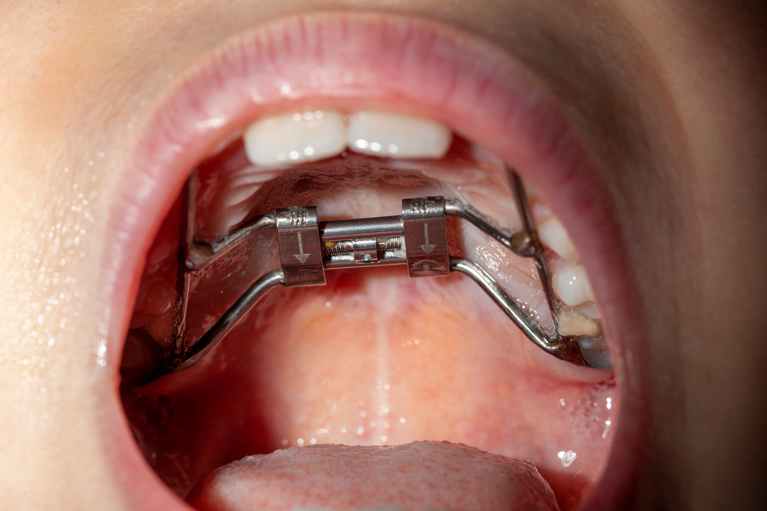 Rapid palatal expander inside mouth