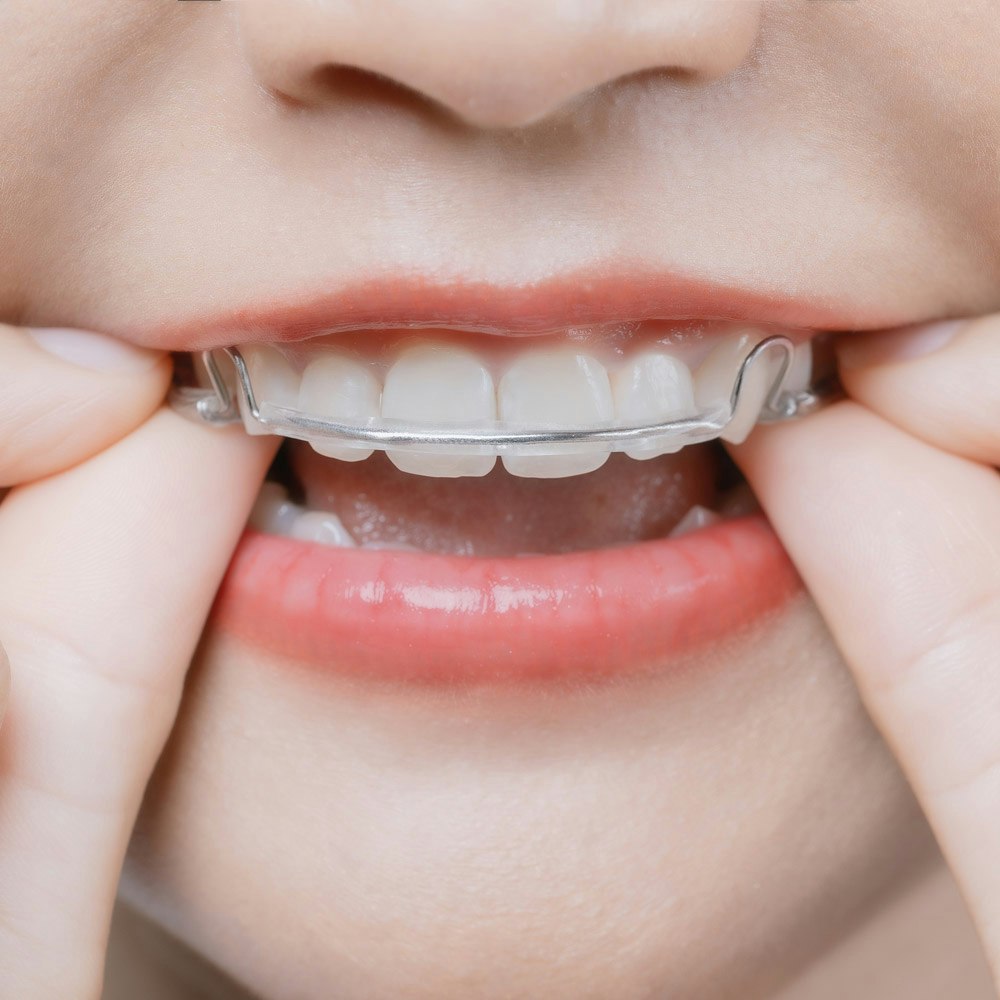 Oral appliance in mouth