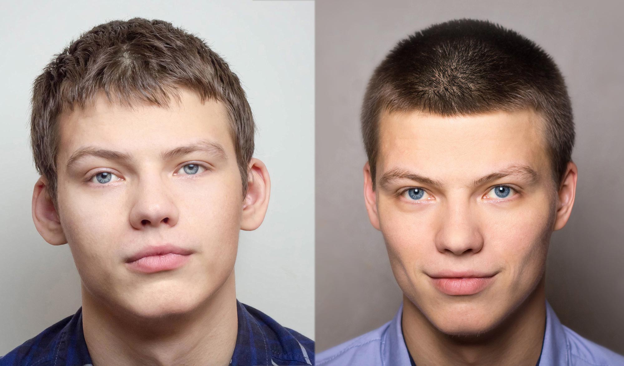 Before and after otoplasty