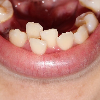 Picture of overcrowded teeth