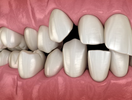 crowded teeth