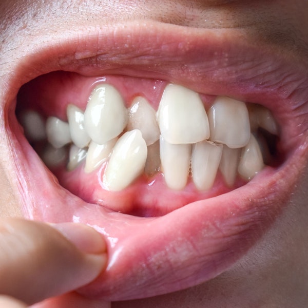 Overcrowded teeth