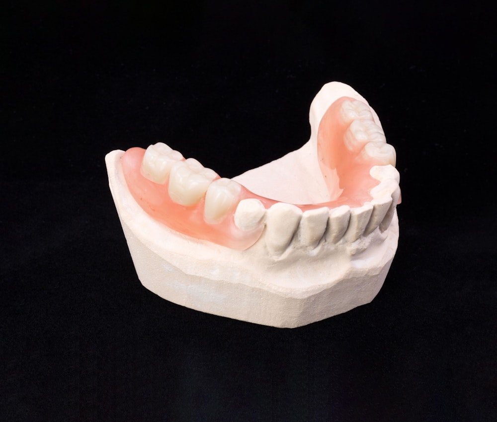Partial Denture