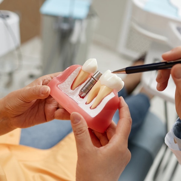 Dental implant model