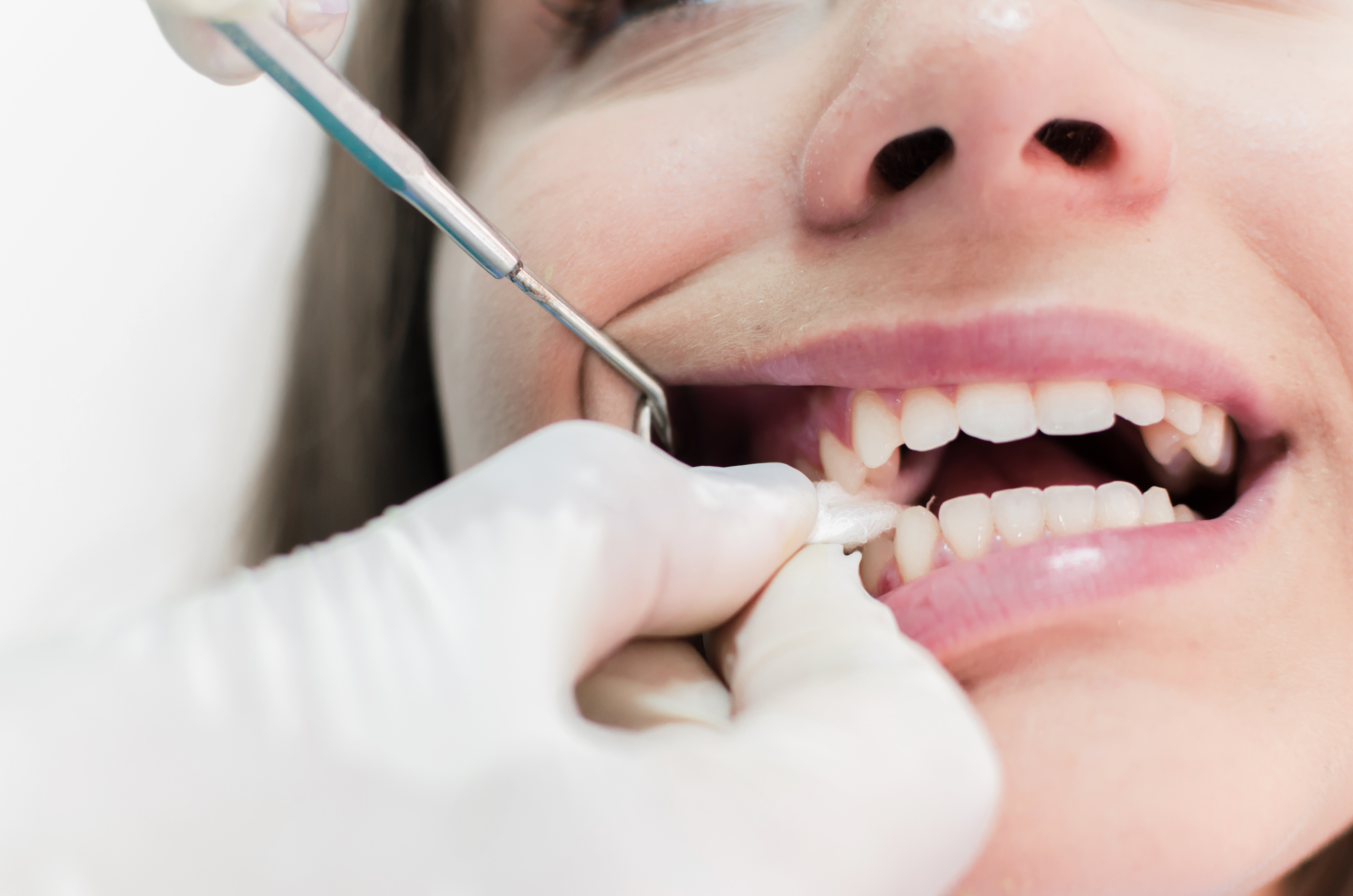 Gauze placed in tooth extraction location