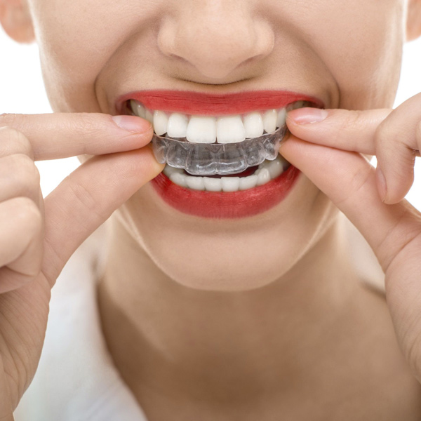 Woman Placing Invisalign Aligner