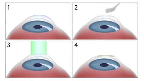 Steps of PRK procedure