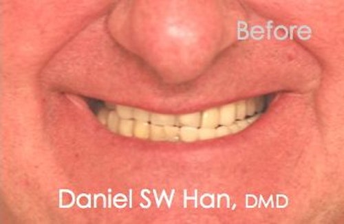 Patient before full mouth rehabilitation