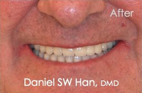 Patient after full mouth rehabilitation