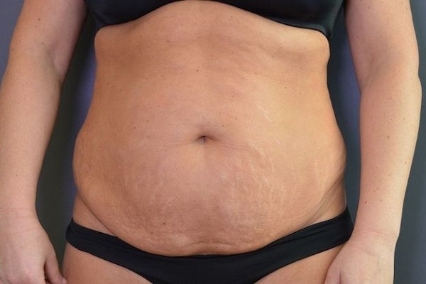 Dr. Kopchinski's Patient Before Tummy Tuck
