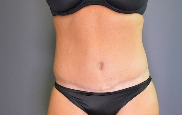 Dr. Kopchinski's Patient After Tummy Tuck