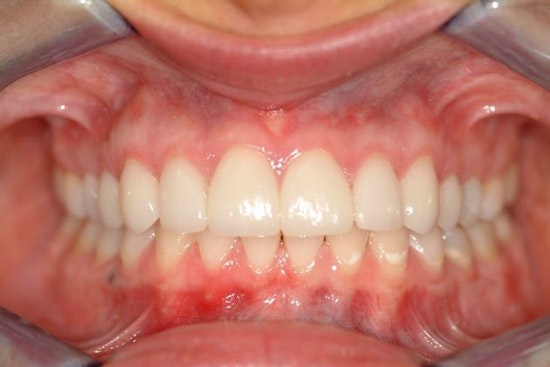 After veneers