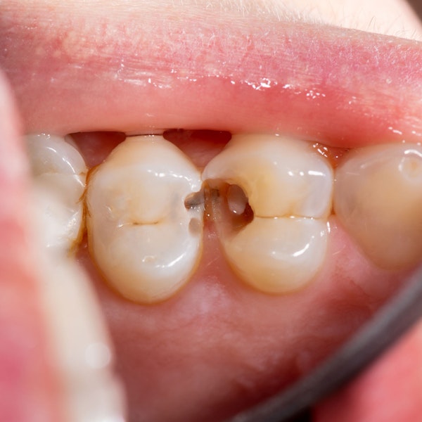 Root canal infection