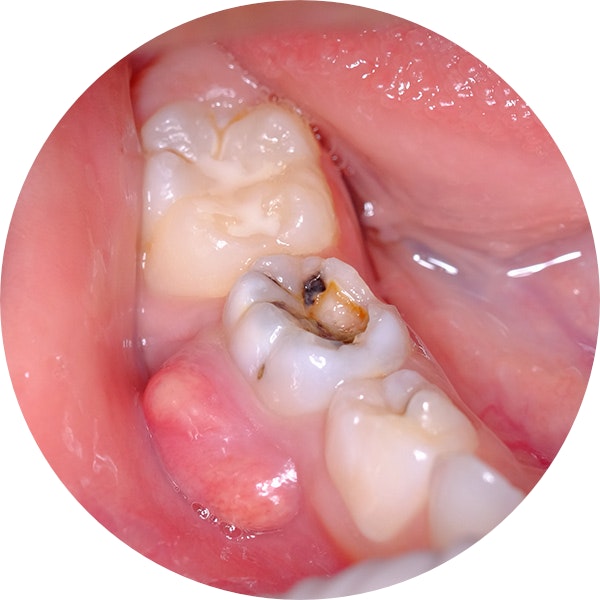infected tooth