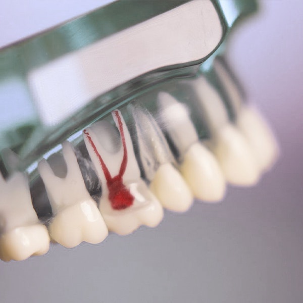 Root Canal prosthetic