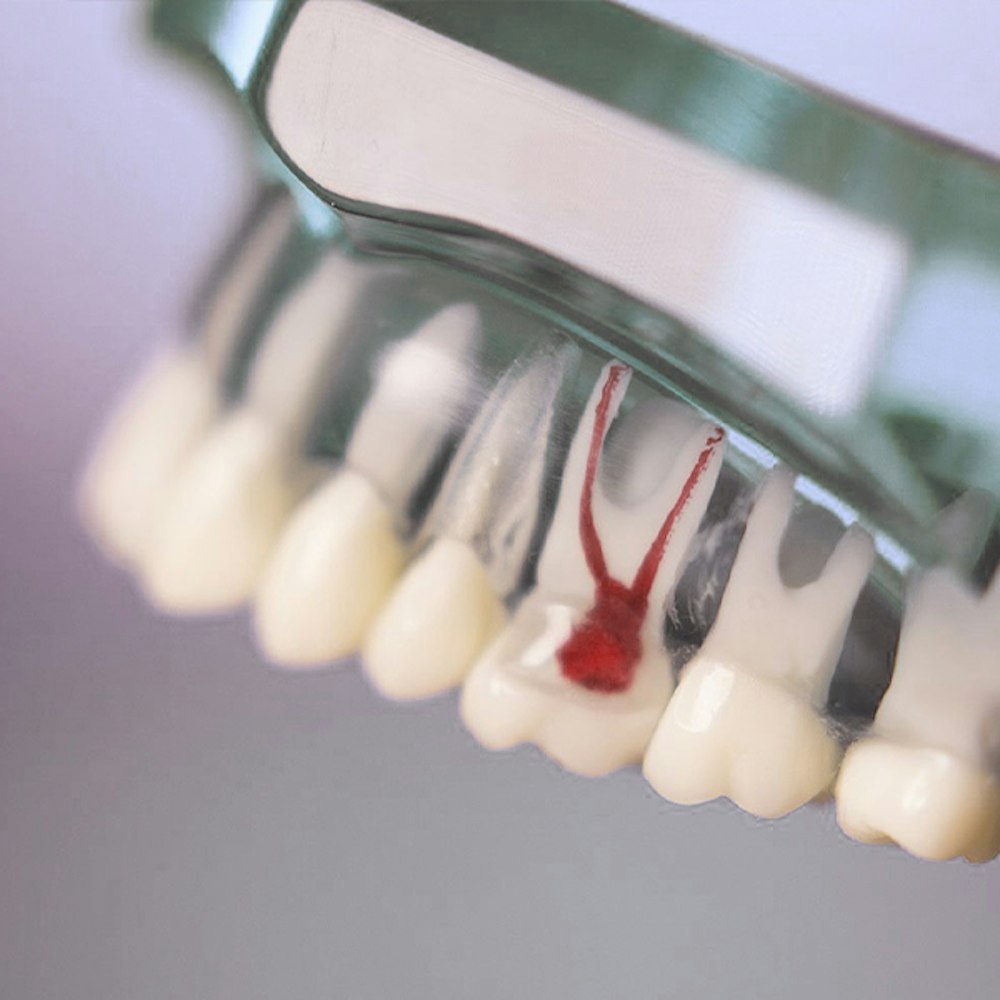 Root Canal