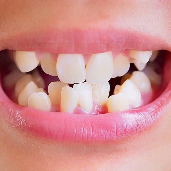 Philadelphia Cavities During Invisalign®: Tooth Decay and