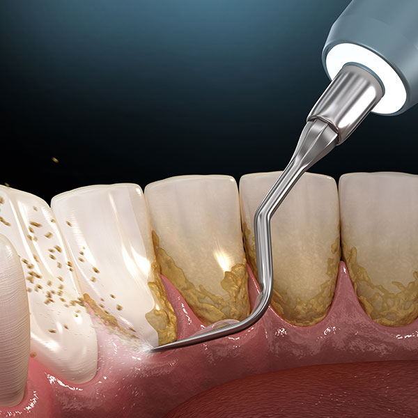 Scaling & Deep Cleaning - Periodontal Therapy - The Brooklyn Dentist