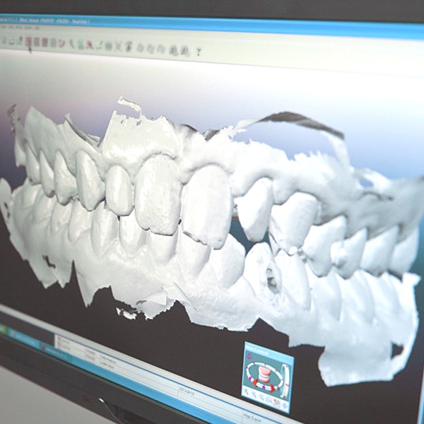 3D digital scan of teeth