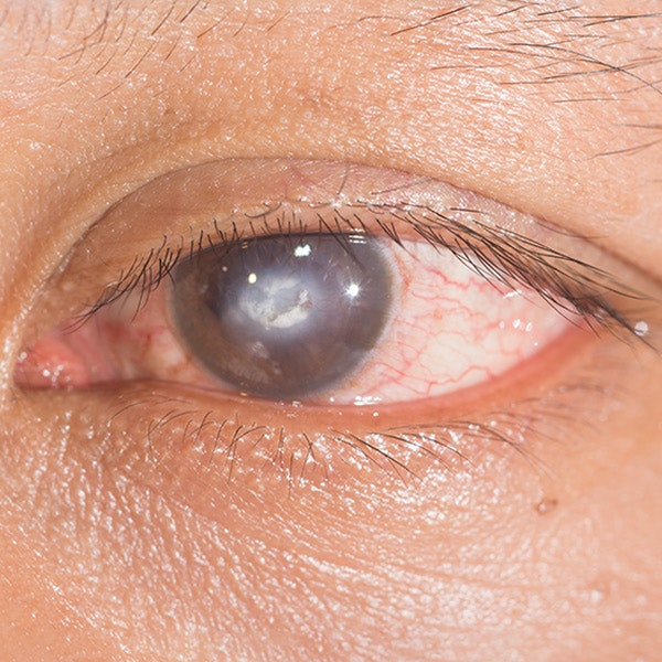 Close-up of detached retina