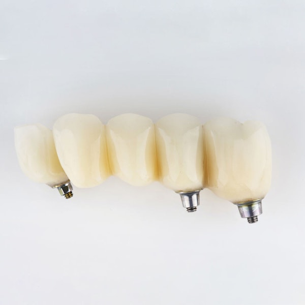 Implant-Supported Bridge