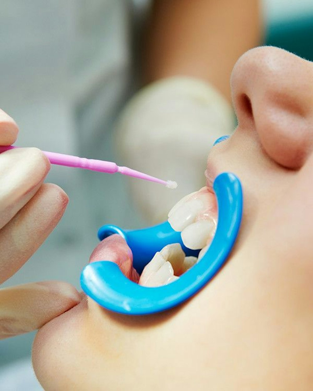 Photo of a dental sealant being provided