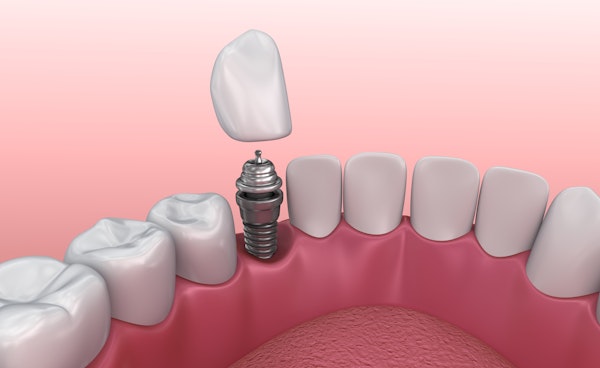 Illustration of implant crown