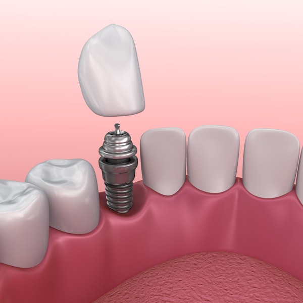 Illustration of implant crown