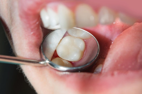 tooth-colored dental filling