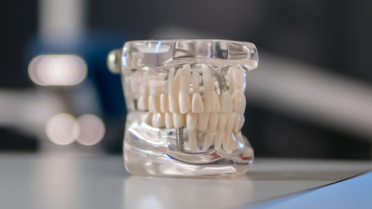 Dental implants model