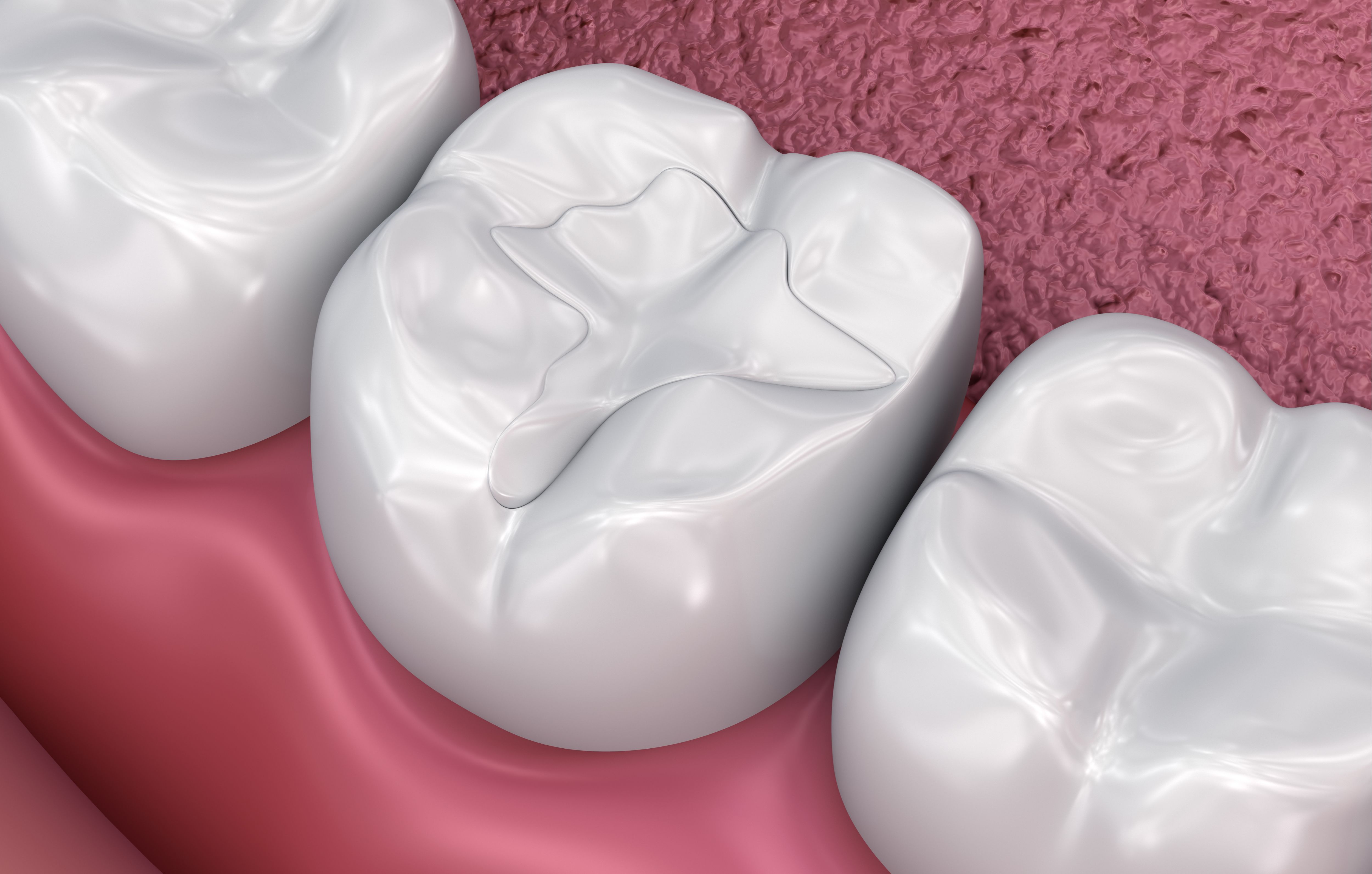 White dental filling