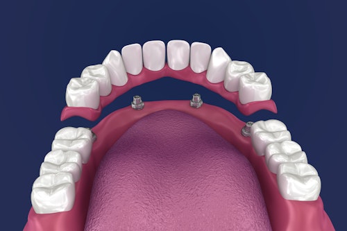 Illustration of partial denture fitting onto implants