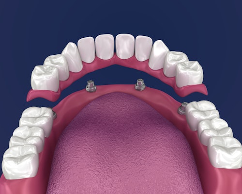 Illustration of partial denture fitting onto implants