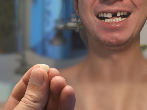 Dislodged dental crown