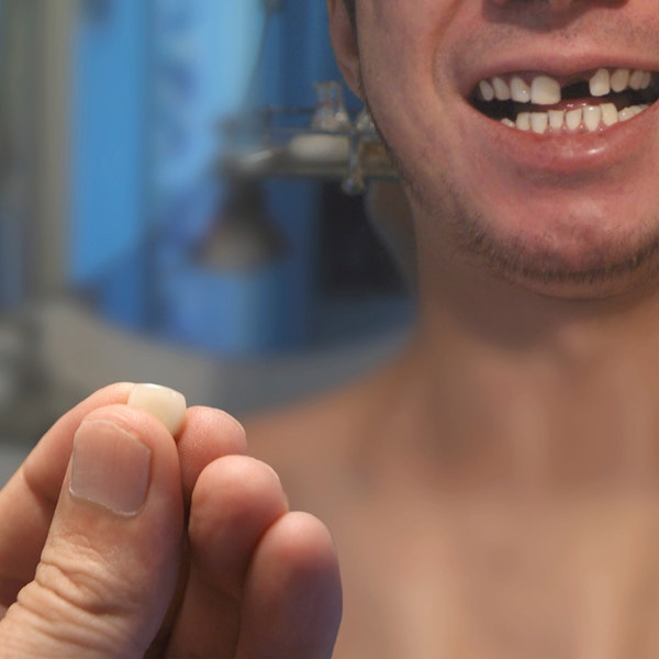 Dislodged dental crown