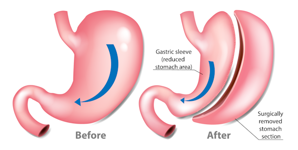 illustration of stomach before and after gastric sleeve